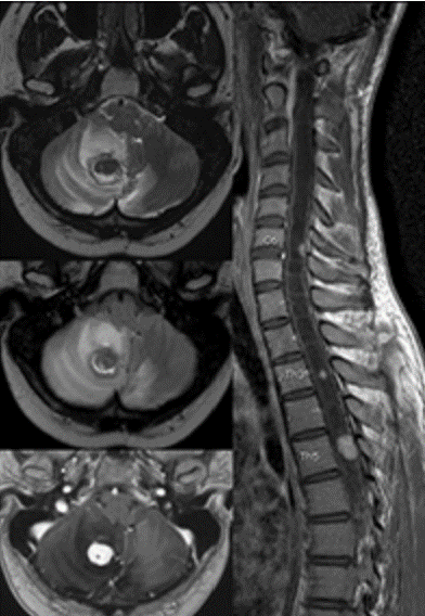 Erasmus Course on Neuro Brain & Spine MRI 2026