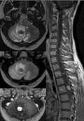 Erasmus Course on Neuro Brain & Spine MRI 2026